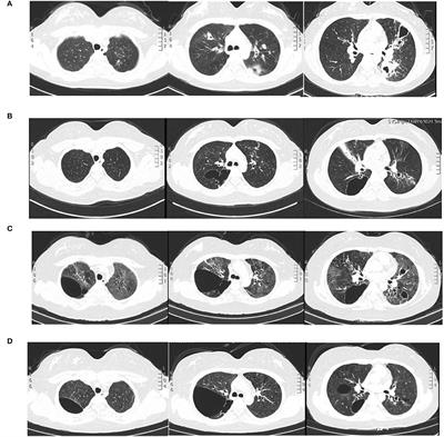 Omalizumab for STAT3 Hyper-IgE Syndromes in Adulthood: A Case Report and Literature Review
